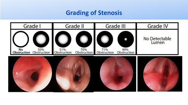 Grading of Stenosis